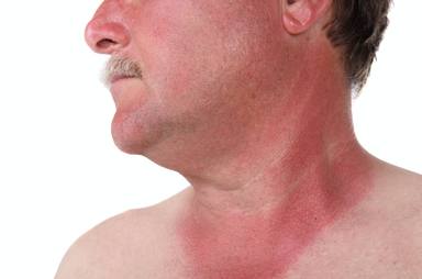 ¿Qué cuidados especiales necesita nuestra piel este verano para tomar el sol?